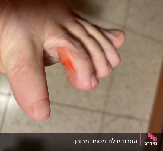 אצבע עם כתם צבע אדום על העור